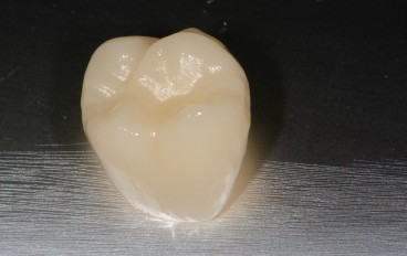 Zahnarztpraxis Dentalfitness Cerec Keramikkrone