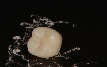 Zahnarztpraxis Dentalfitness Vollkeramikkrone