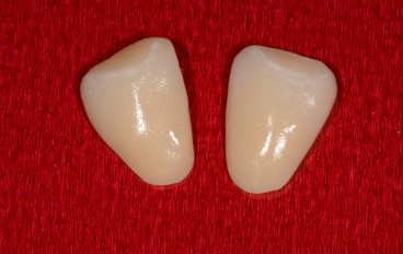 Zahnarztpraxis Dentalfitness Keramikveneers Frontzähne