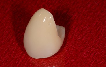 Zahnarztpraxis Dentalfitness Eckzahn Vollkeramikkrone