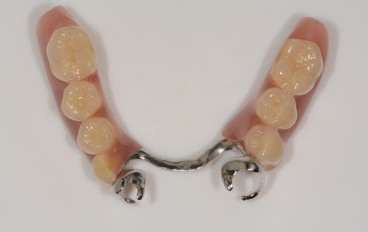 Zahnarztpraxis Dentalfitness Modellgussteilprothese