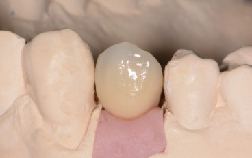 Zahnarztpraxis Dentalfitness Implantatkrone Modell