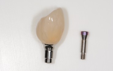 Zahnarztpraxis Dentalfitness Implantatkrone