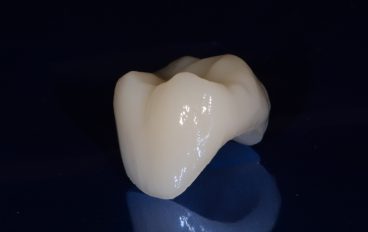 Zahnarztpraxis Dentalfitness Keramikkrone