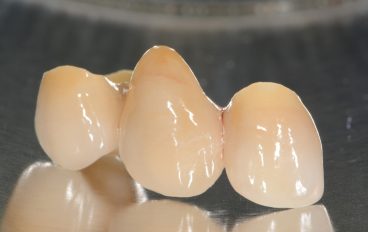 Zahnarztpraxis Dentalfitness Vollkeramikbrücke