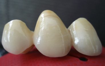 Zahnarztpraxis Dentalfitness Vollkeramikbrücke